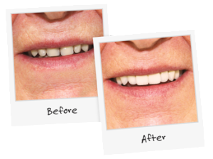 Denture Clinic Before and After